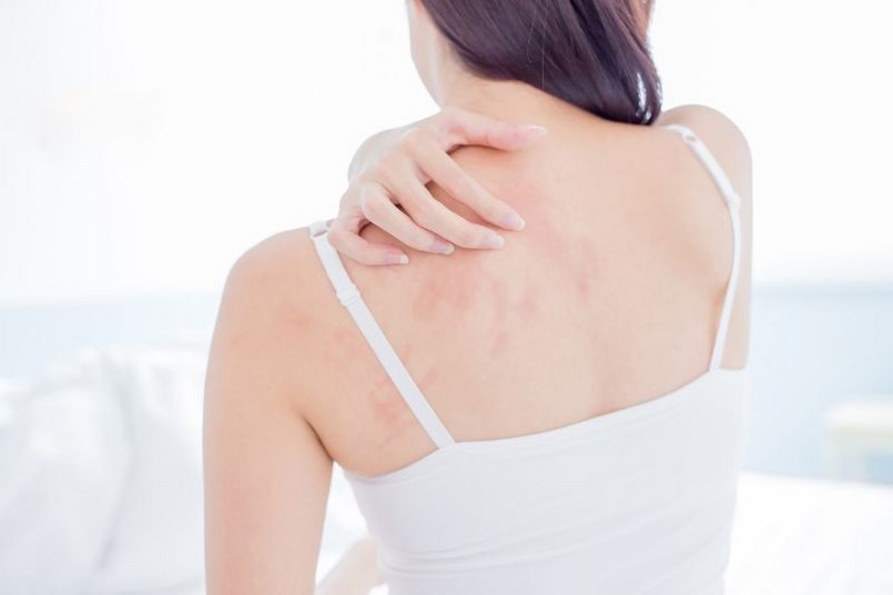Cách chăm sóc da body bị dị ứng