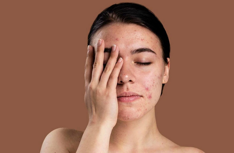 Nguyên tắc chăm sóc da nhạy cảm để trắng sáng