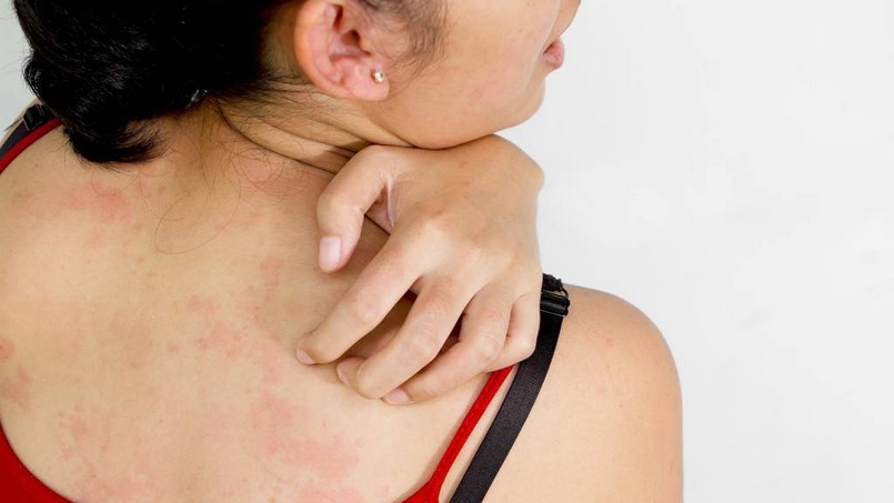 Cách trị ngứa da body hiệu quả