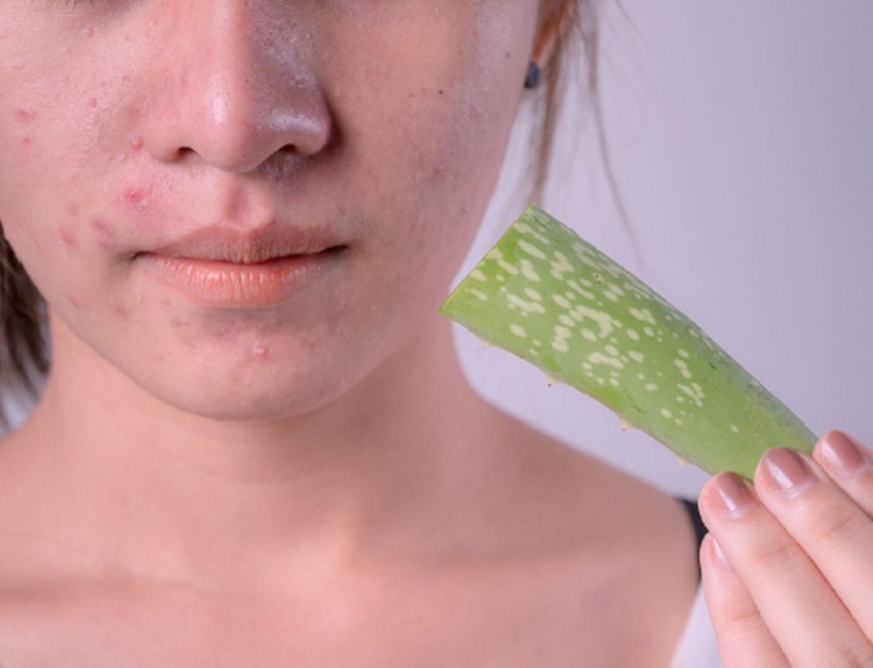 Lợi ích của nha đam trong việc trị viêm nang lông