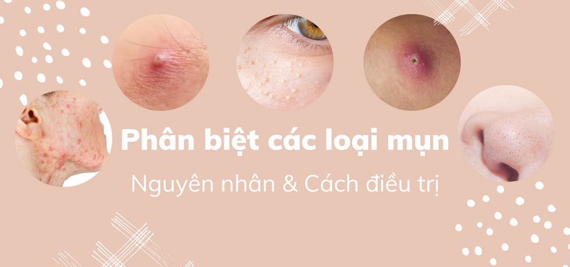 Sự khác biệt giữa mụn viêm và mụn không viêm