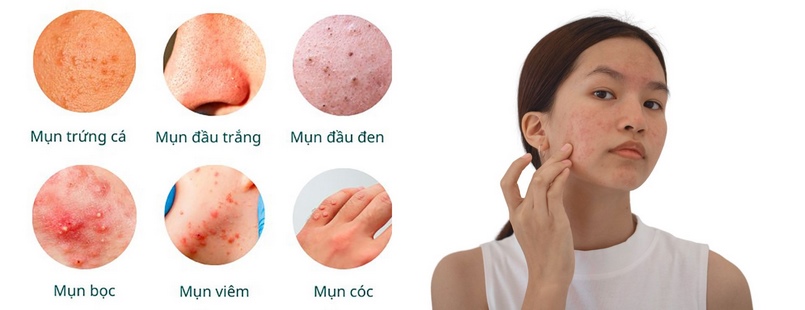 Phương pháp điều trị mụn không viêm