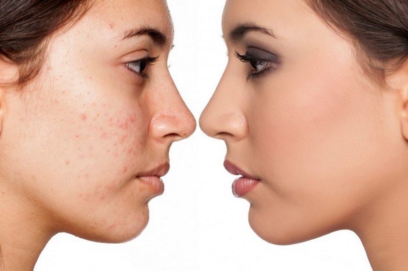 Điều trị mụn hiệu quả với các nguyên liệu thiên nhiên lành tính